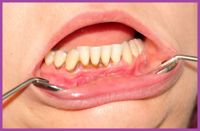 cao răng của răng bị viêm nha chu