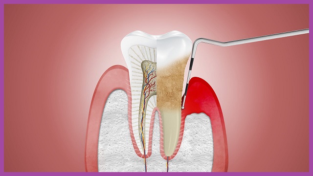 cấu trúc răng bị viêm nha chu bệnh học