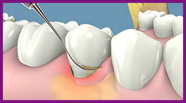 Chữa viêm nha chu bằng phương pháp lấy cao răng