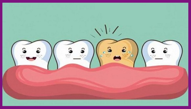mảng bám hình thành trên răng sẽ gây ố vàng răng, kém theo hiện tượng nướu bị kích thích