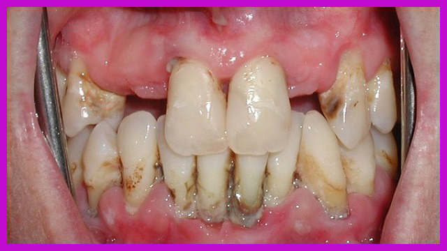 dấu hiệu bệnh răng viêm nha chu