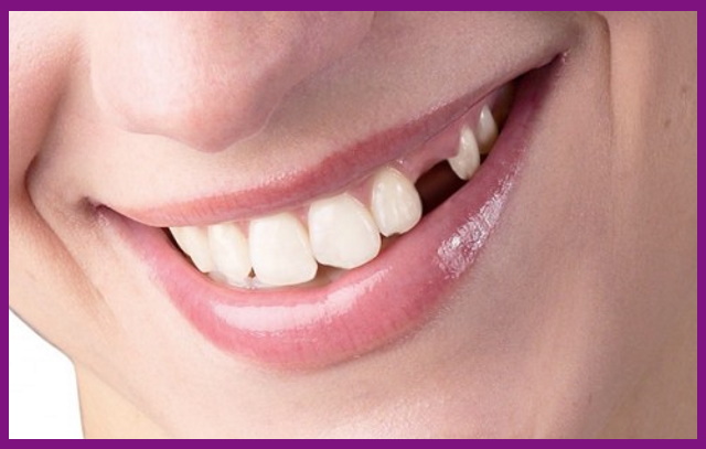 viêm nha chu trở nặng có nguy cơ làm mất răng vĩnh viễn