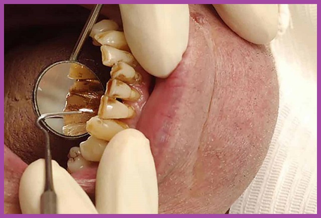 giữ vệ sinh răng không tốt dẫn đến viêm nha chu triệu chứng