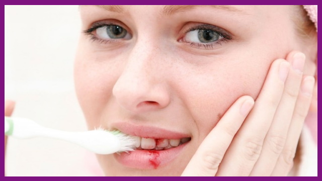 khi bị viêm nha chu đánh răng sẽ thấy chảy máu chân răng