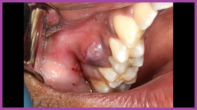 phẫu thuật bệnh nha chu răng miệng