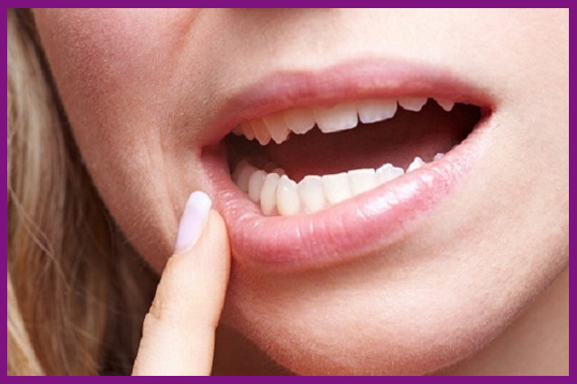viêm nha chu chuyển sang mức độ nặng sẽ khiến răng bạn bị lung lay