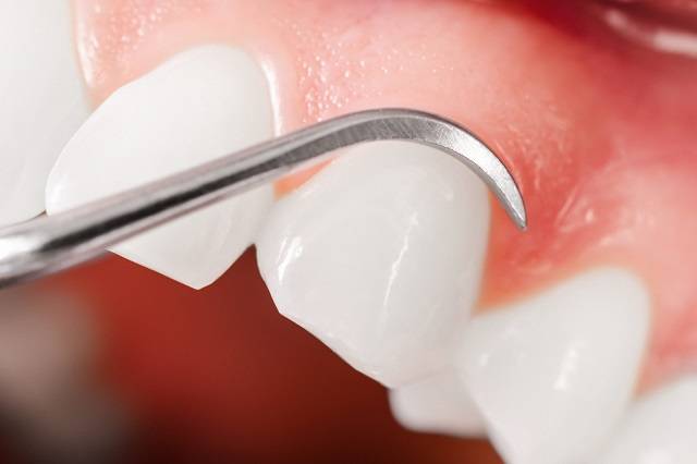 Cách chữa viêm nha chu răng chỉ với các bước đơn giản