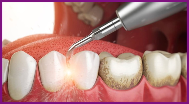 cạo vôi răng là cách điều trị dành cho thể nha chu nhẹ