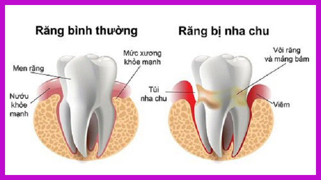 viêm nha chu chân răng là gì