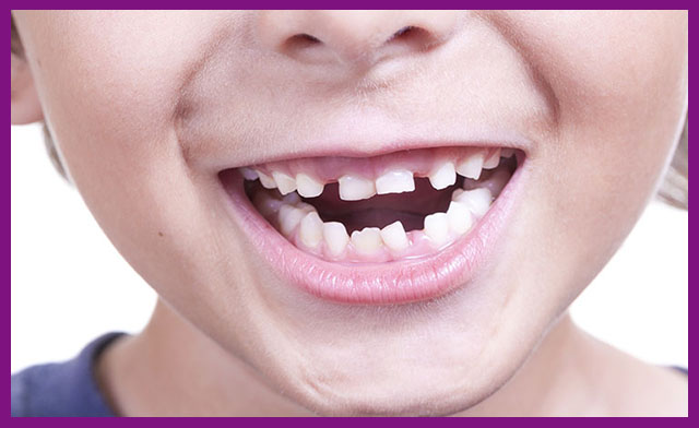 Viêm nha chu trẻ em ảnh hưởng răng vĩnh viễn