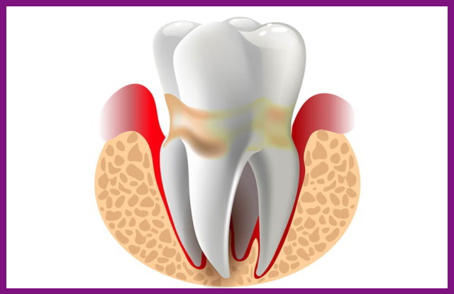viêm nha chu sẽ làm nướu bị sưng đỏ và dính các mảng bám ố vàng quanh răng